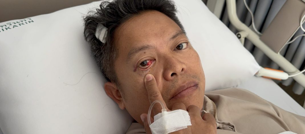 “บอนด์” อดีตผู้สมัคร สส.ปชป. ถูกเจ้าของร้านเหล้าบางบ่อฟาดหัวเลือดอาบ กระดูกร้าวรอบดวงตา ปากแตก หัวแตก ลั่นออกจาก รพ. แจ้งความเอาผิดถึงที่สุด